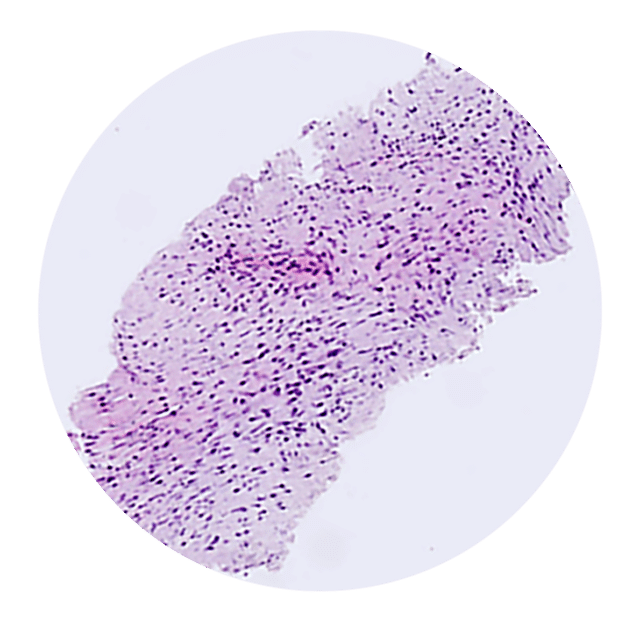 Bilden visar Intakta, stora vävnadsprover som möjliggör histologisk diagnos av desmoid tumör i magsäcken (4X, H&E)