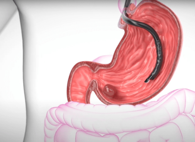 Endoskopiskt ultraljud (EUS)